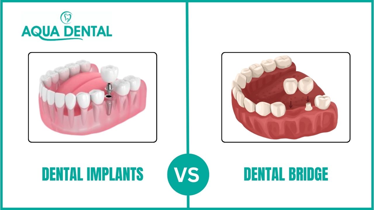dental implant versus bridge cost