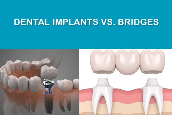 dental implant versus bridge cost