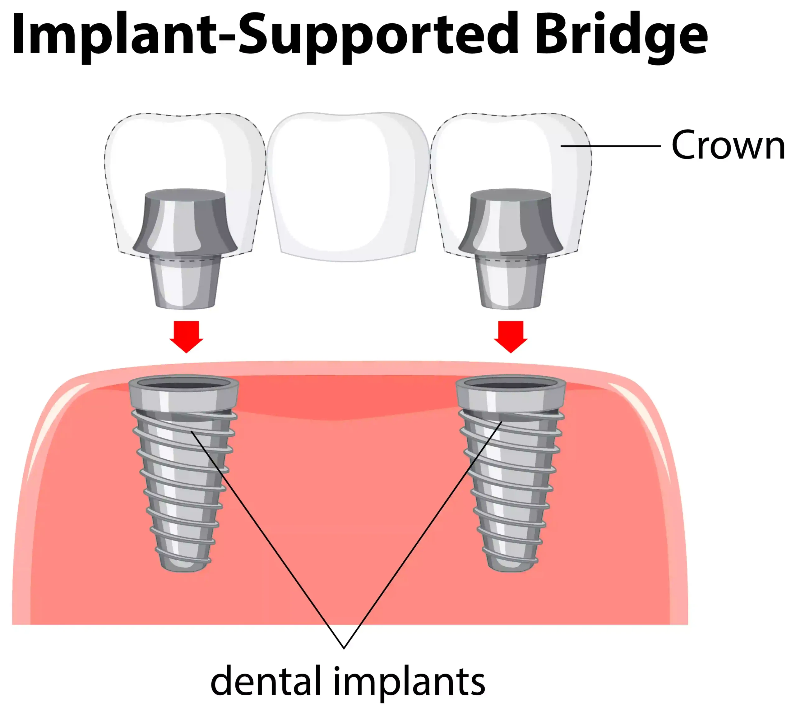 dental implant versus bridge cost
