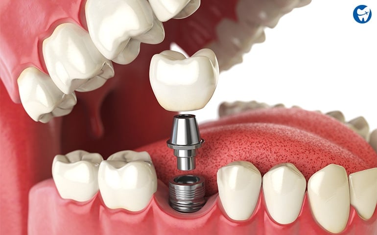 dental implants vs dentures cost Dental Equipment