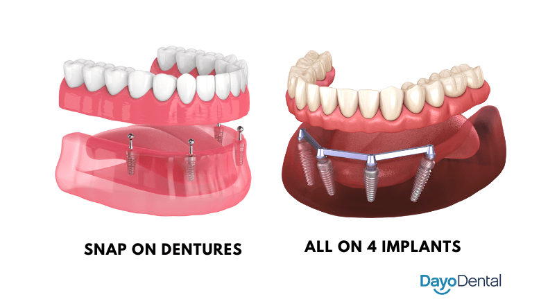 dental implants vs dentures cost
