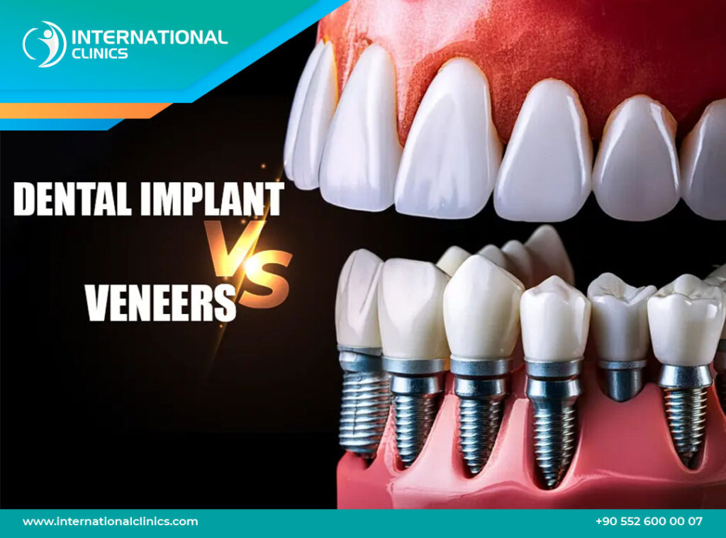 dental implants vs veneers cost Dental Equipment