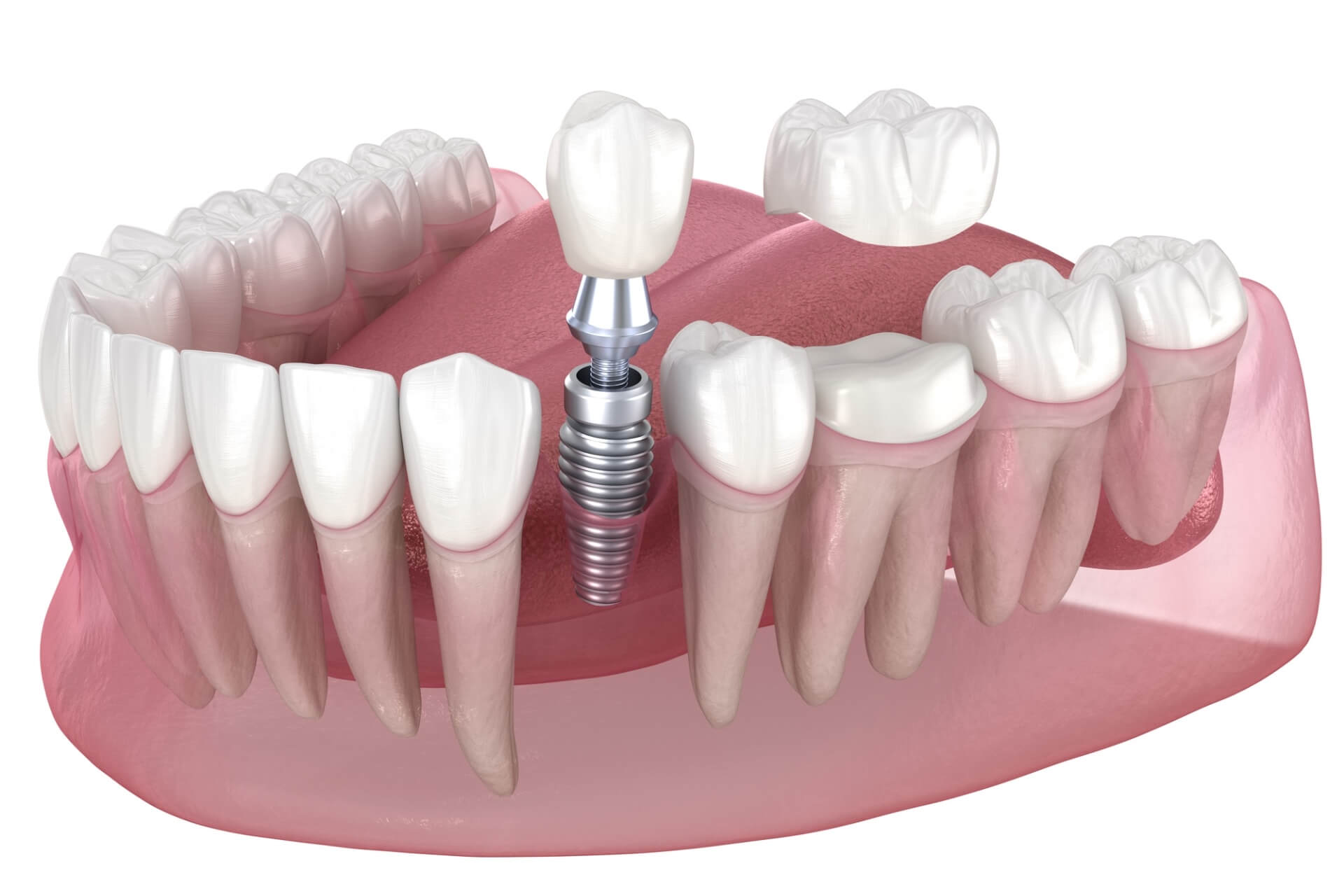 dental implants vs veneers cost