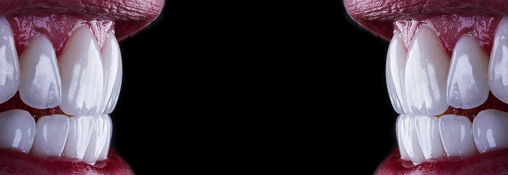 dental implants vs veneers cost