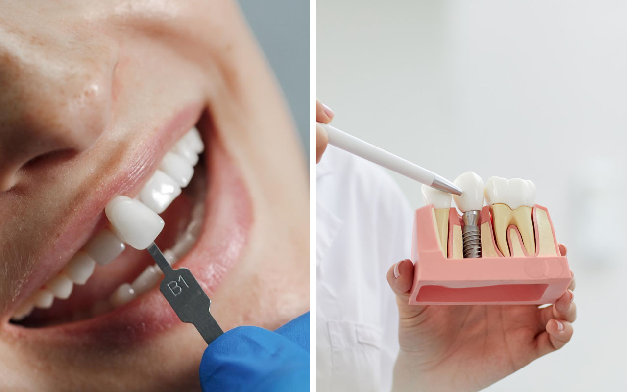dental implants vs veneers cost