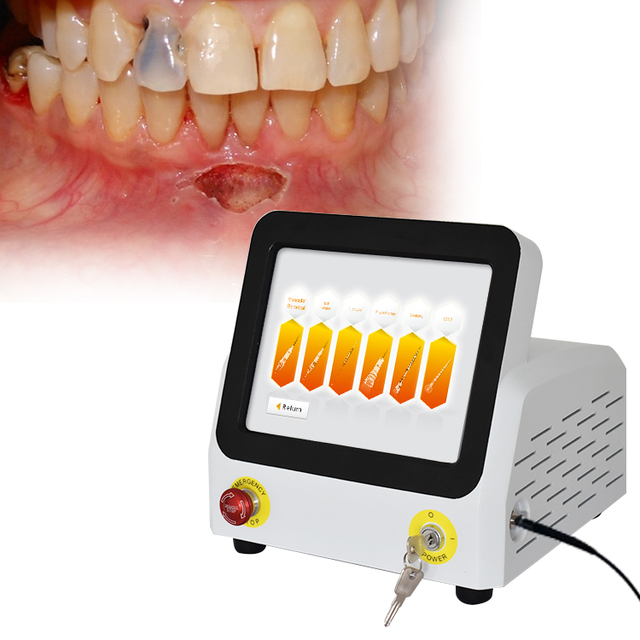 gingivectomy laser machine