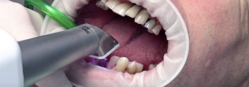 impronta dentale con scanner